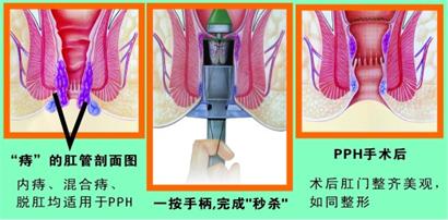 库车肛肠治疗技术PPH微创术